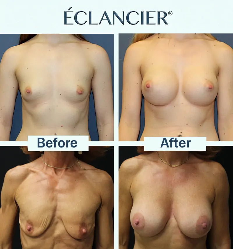 ÉCLANCIER® Targeted Breast Enhancement Advanced Nano Microneedle Patch❤️